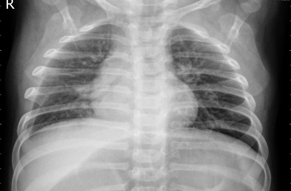Pneumonia — NIH Chest X-ray14