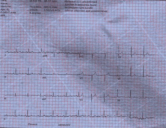 Normal ECG — PTB-XL