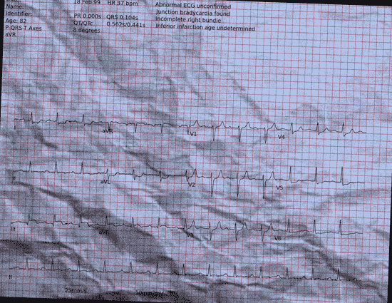 Normal ECG — PTB-XL
