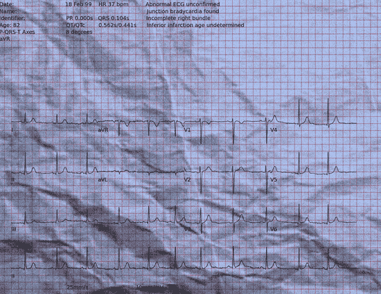 Normal ECG — PTB-XL