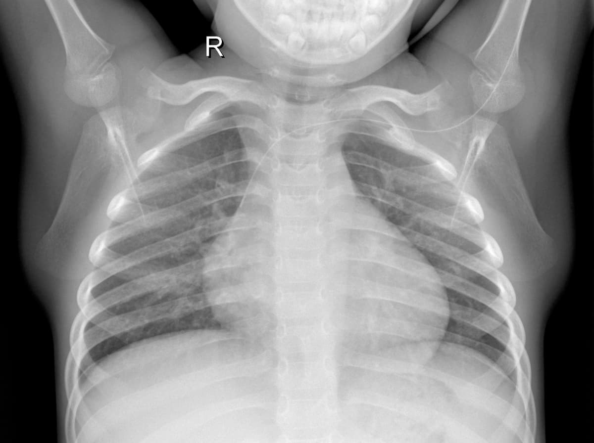 Radiografia Normal — NIH Chest X-ray14