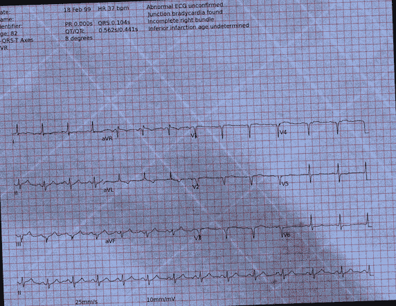 Normal ECG — PTB-XL