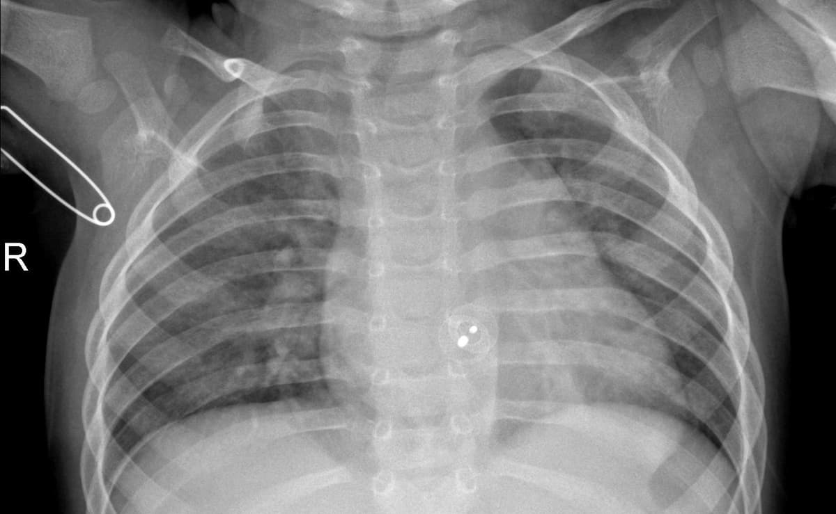 Pneumonia — NIH Chest X-ray14