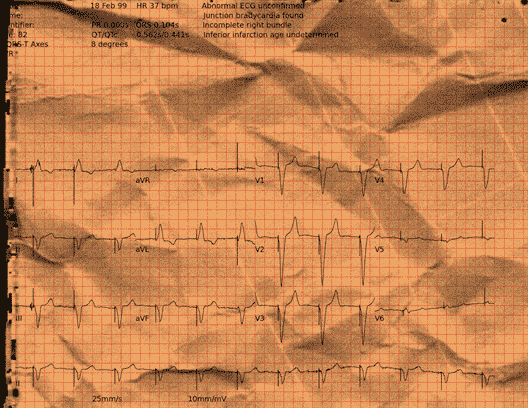 Normal ECG — PTB-XL