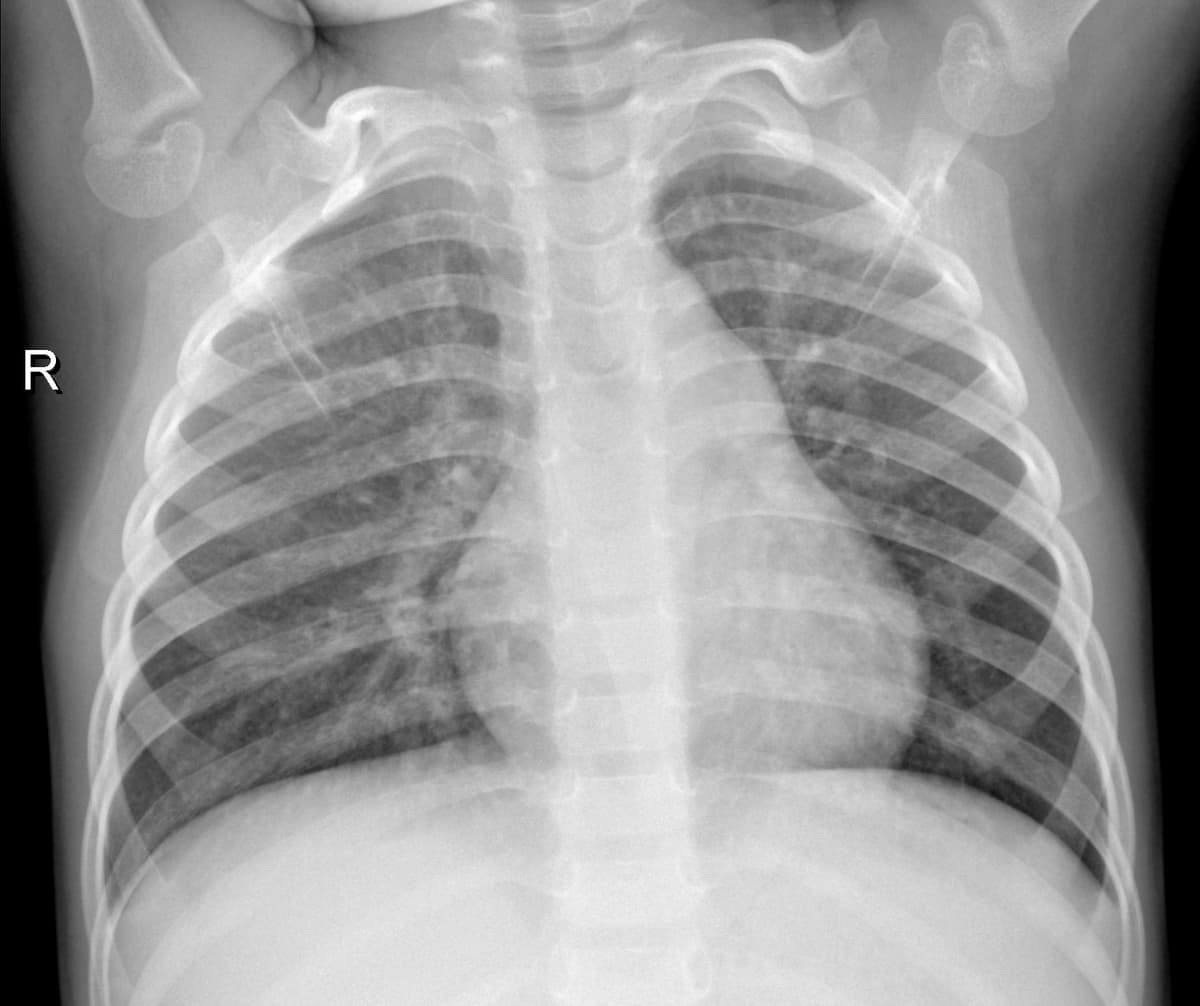 Radiografia Normal — NIH Chest X-ray14