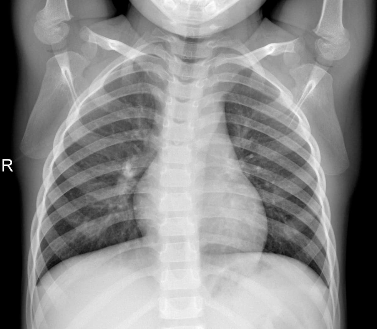 Radiografia Normal — NIH Chest X-ray14