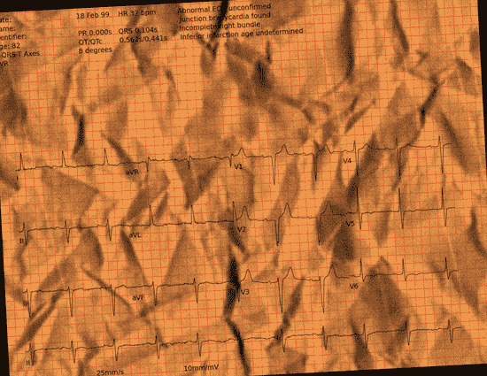 Normal ECG — PTB-XL
