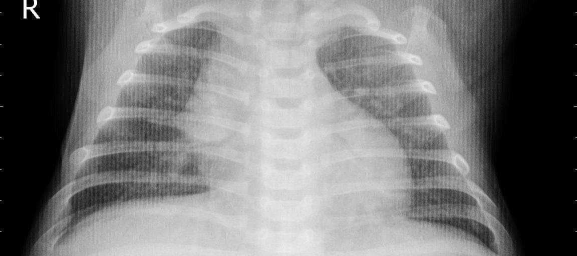 Pneumonia — NIH Chest X-ray14