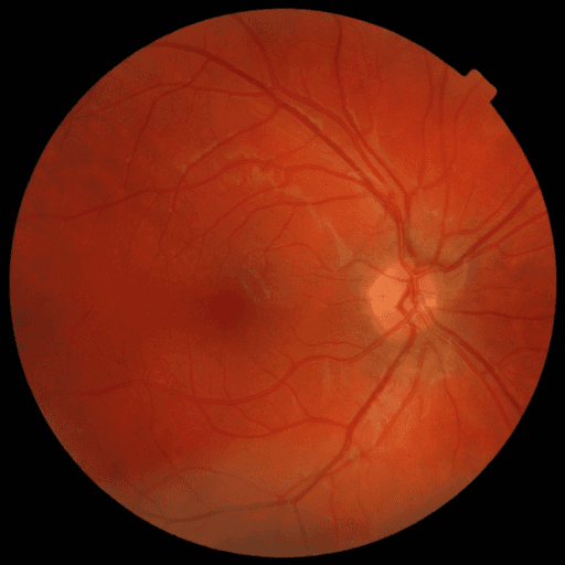 No Diabetic Retinopathy — MESSIDOR-2