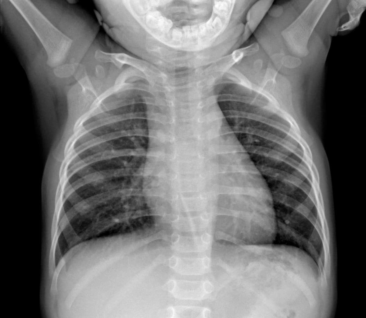 Radiografia Normal — NIH Chest X-ray14