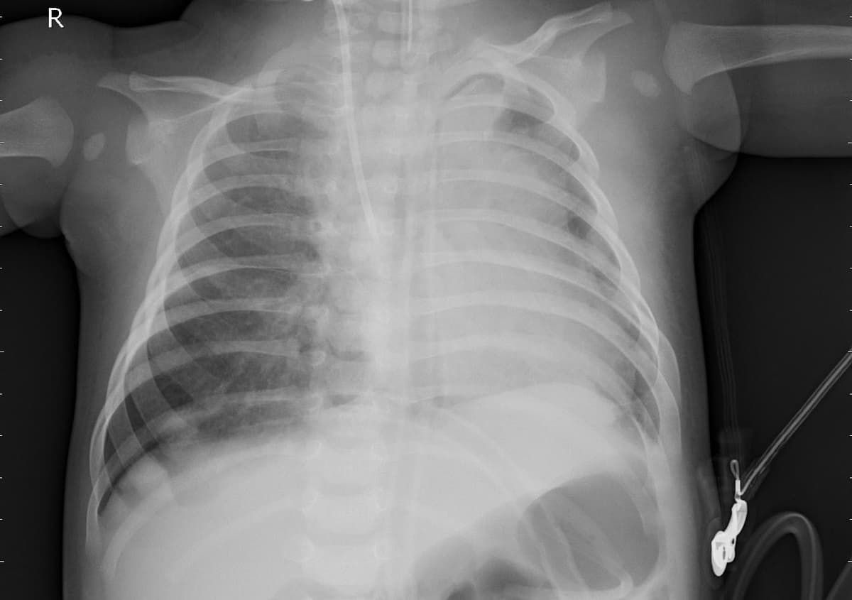 Pneumonia — NIH Chest X-ray14