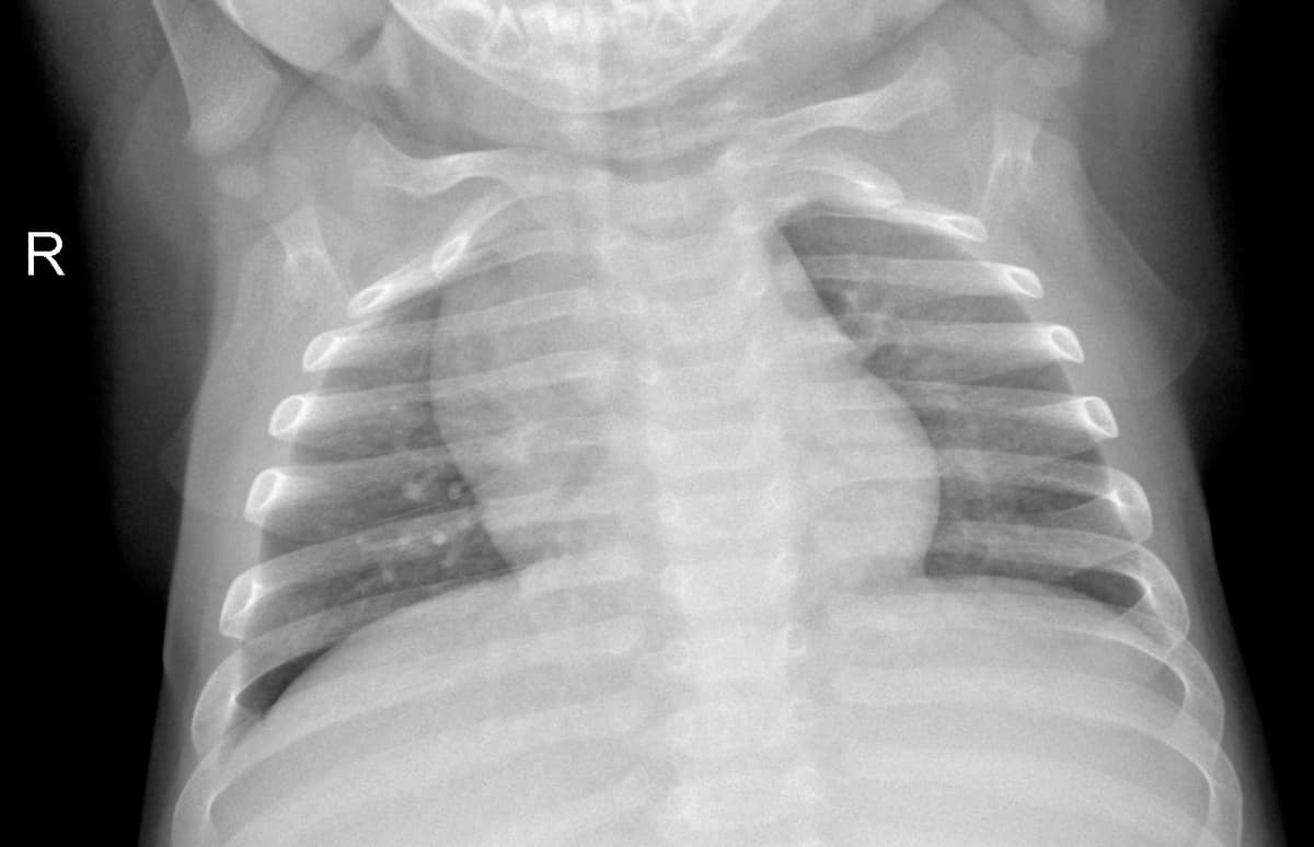 Radiografia Normal — NIH Chest X-ray14