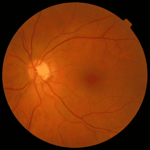 No Diabetic Retinopathy — MESSIDOR-2