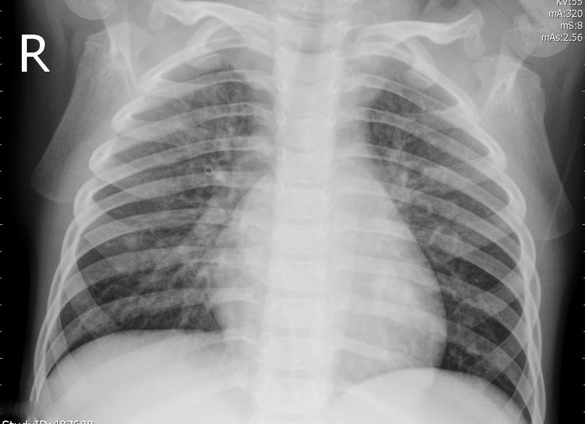 Pneumonia — NIH Chest X-ray14