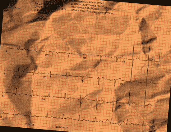Normal ECG — PTB-XL