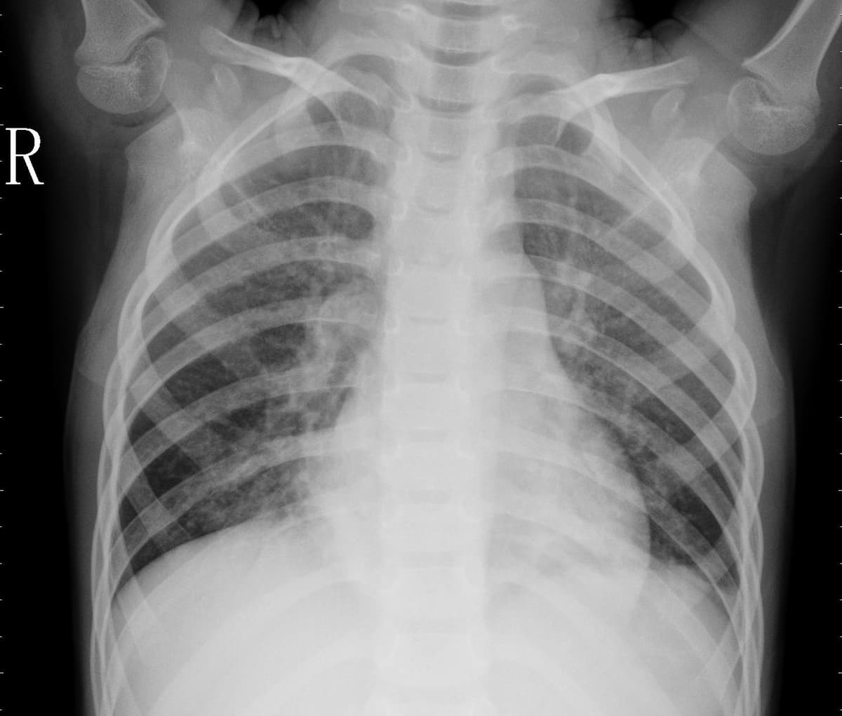 Pneumonia — NIH Chest X-ray14