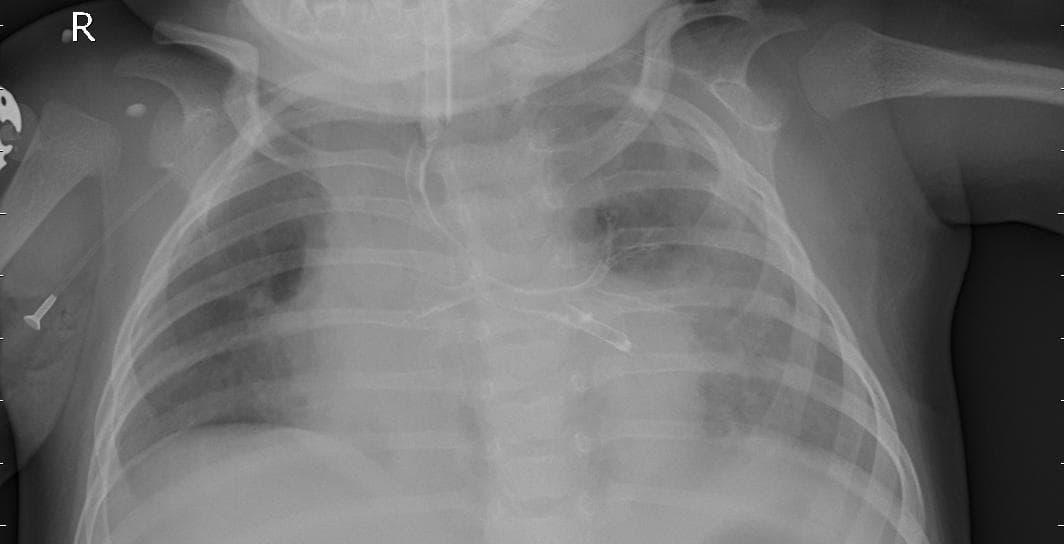 Pneumonia — NIH Chest X-ray14