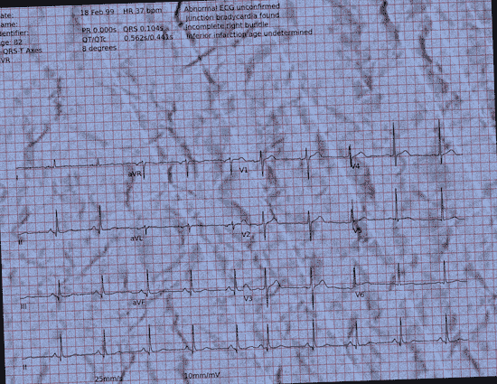 Normal ECG — PTB-XL