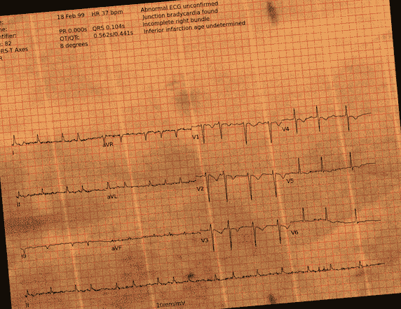 Normal ECG — PTB-XL