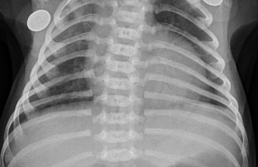 Pneumonia — NIH Chest X-ray14