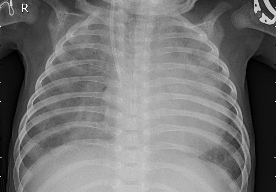 Pneumonia — NIH Chest X-ray14
