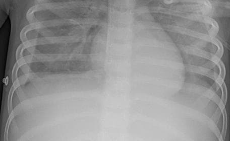 Pneumonia — NIH Chest X-ray14