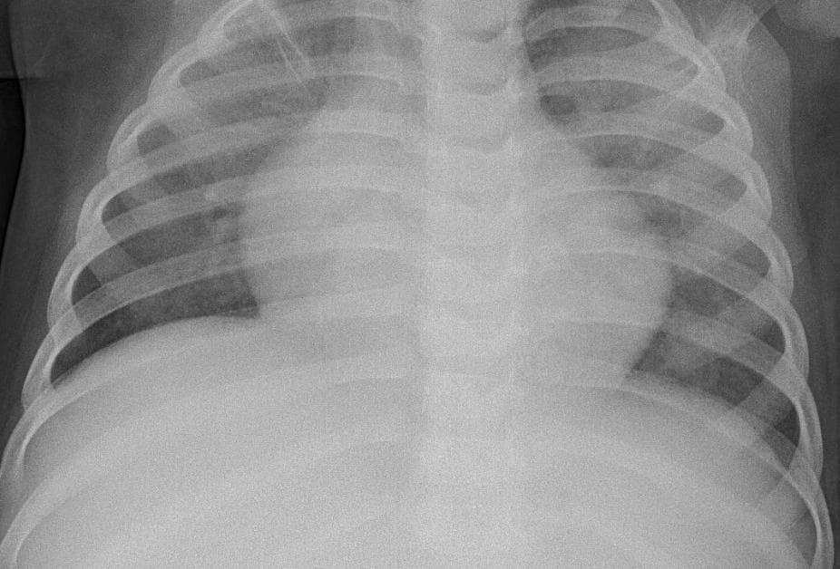 Pneumonia — NIH Chest X-ray14