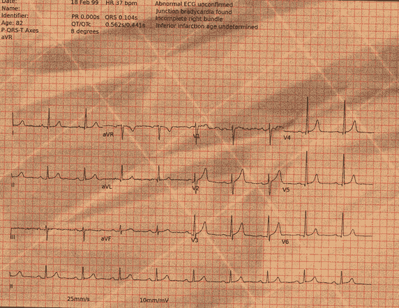 Normal ECG — PTB-XL