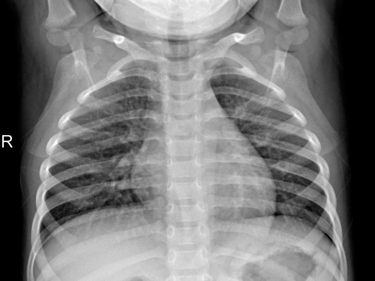 Radiografia Normal — NIH Chest X-ray14