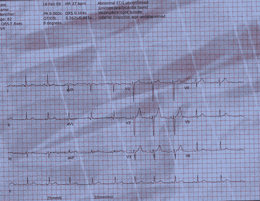 Normal ECG — PTB-XL