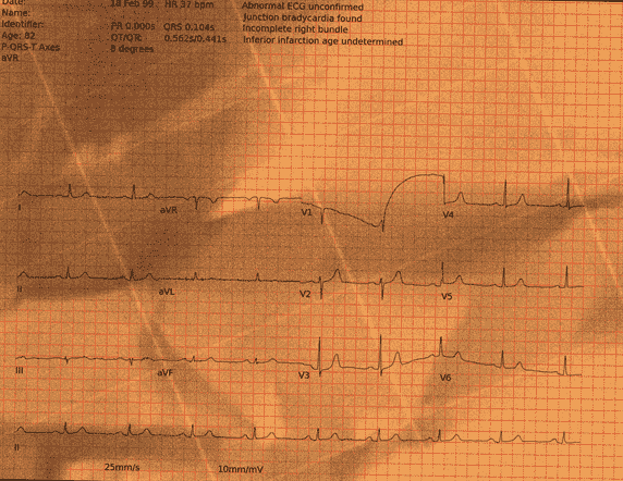 Normal ECG — PTB-XL
