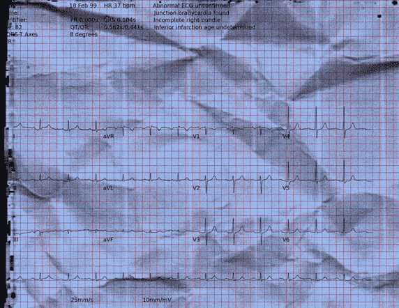 Normal ECG — PTB-XL