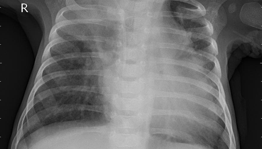 Pneumonia — NIH Chest X-ray14