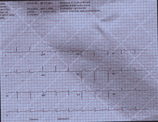 Normal ECG — PTB-XL