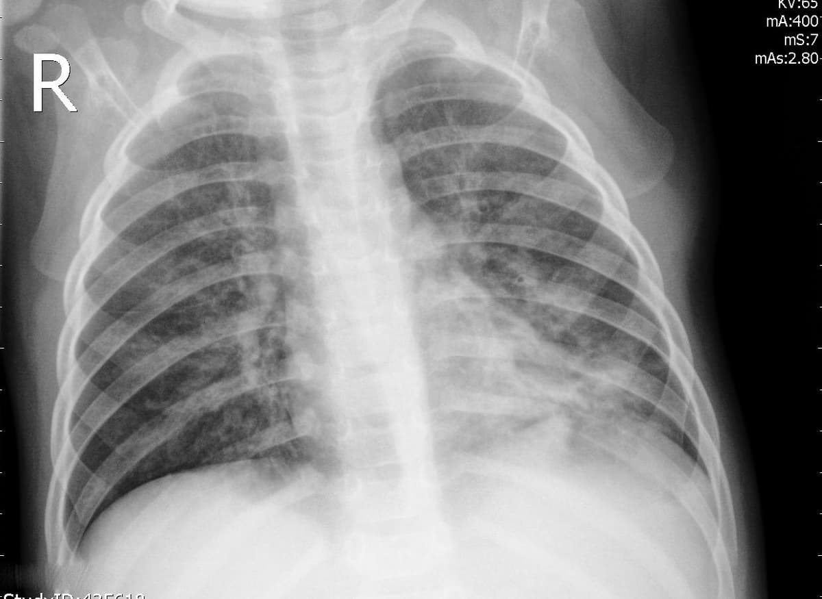 Pneumonia — NIH Chest X-ray14