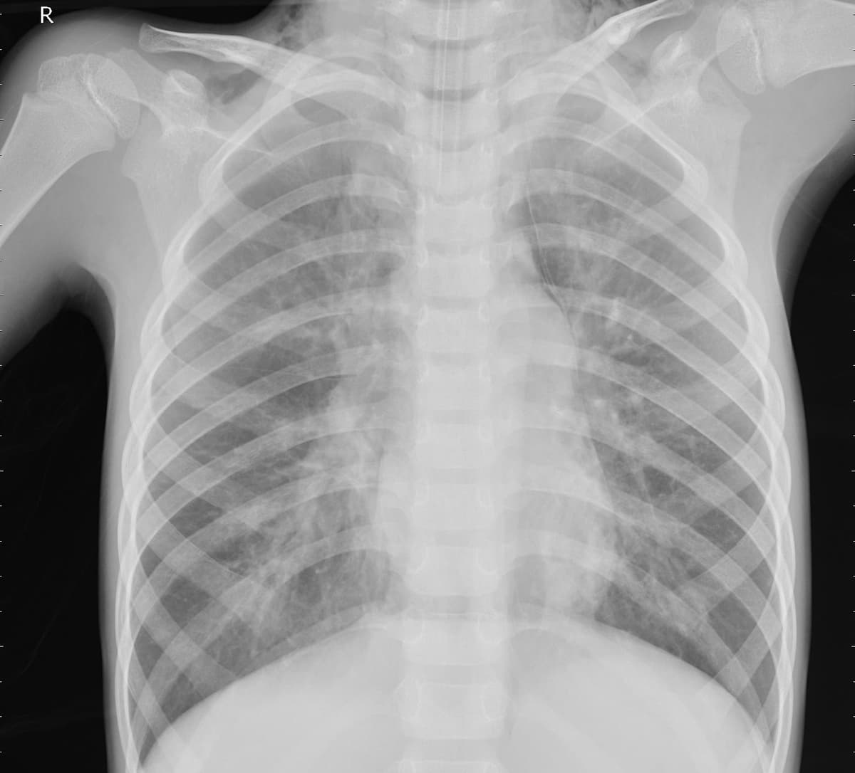 Pneumonia — NIH Chest X-ray14