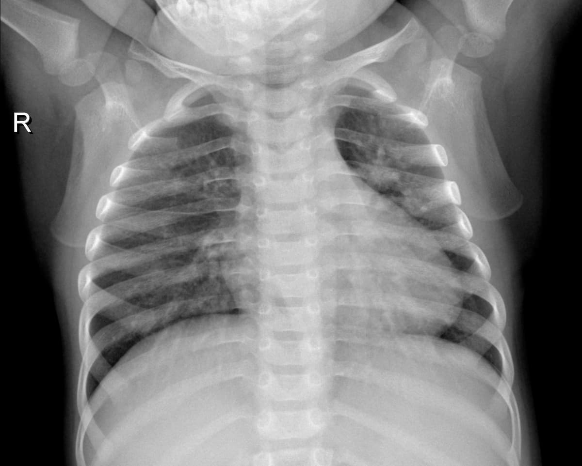 Radiografia Normal — NIH Chest X-ray14