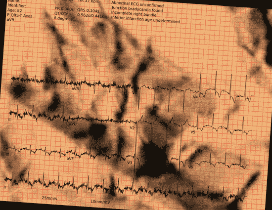 Normal ECG — PTB-XL