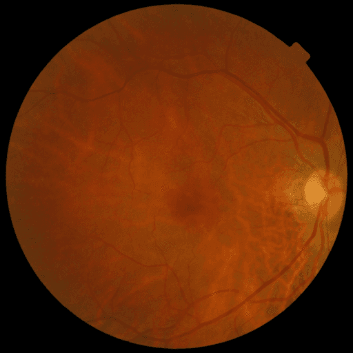 Proliferative DR — MESSIDOR-2