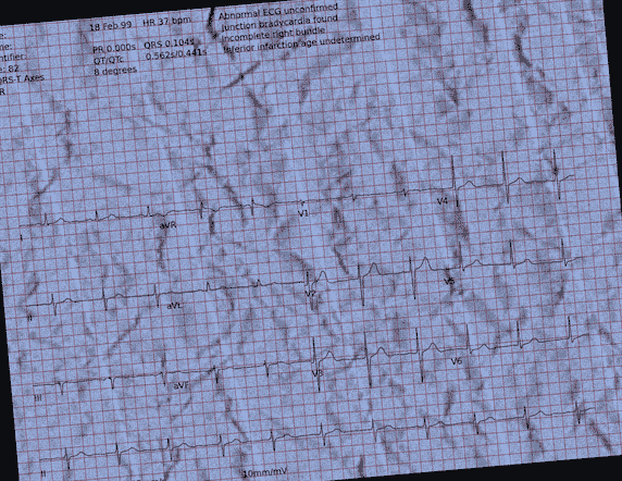 Normal ECG — PTB-XL