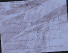 Normal ECG — PTB-XL
