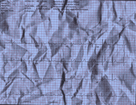 Normal ECG — PTB-XL