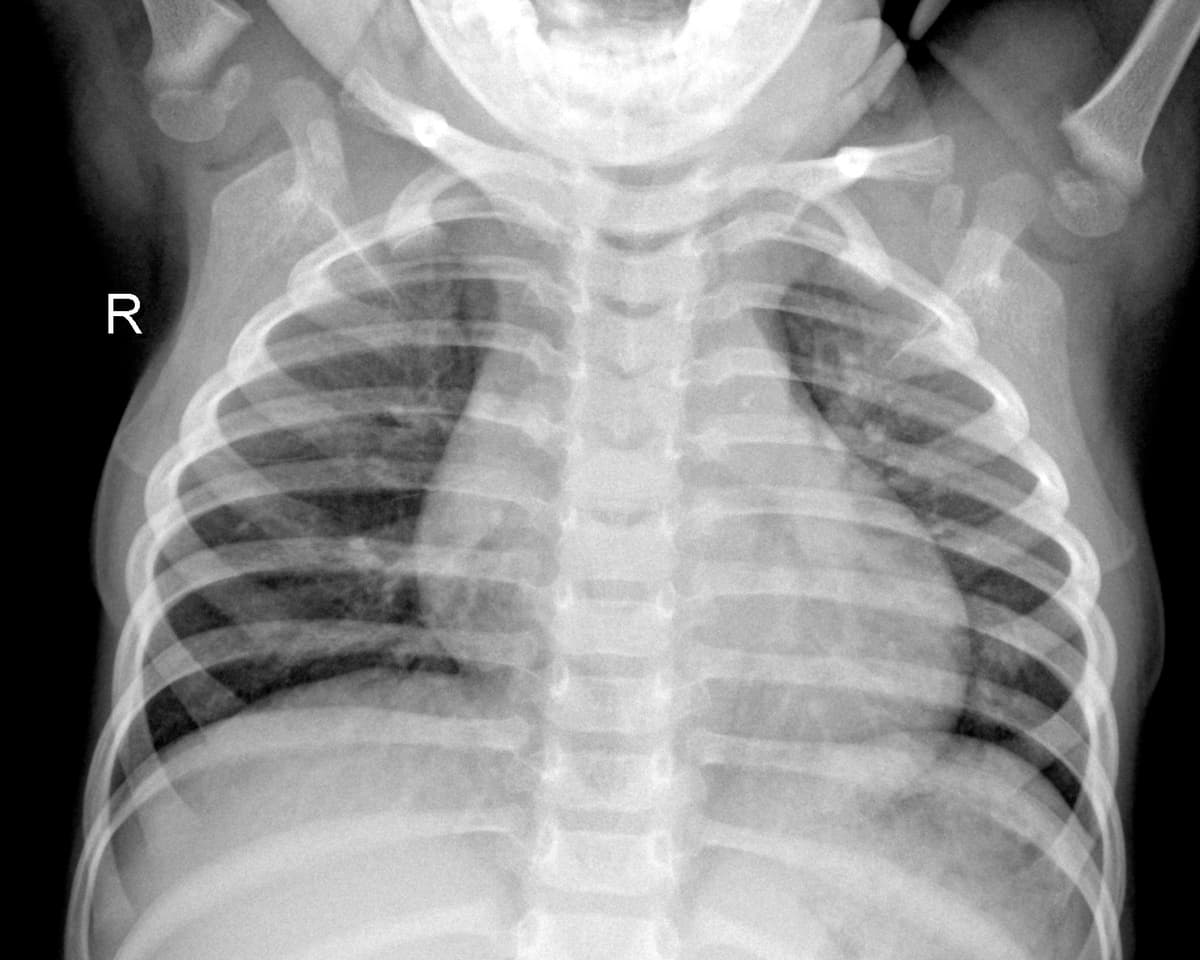 Radiografia Normal — NIH Chest X-ray14