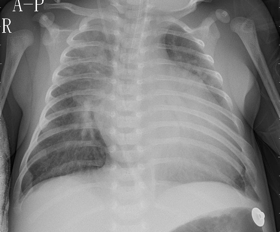 Pneumonia — NIH Chest X-ray14