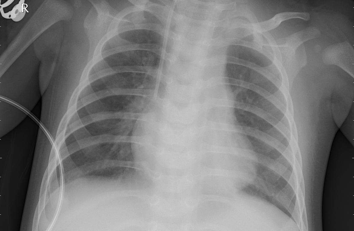 Pneumonia — NIH Chest X-ray14