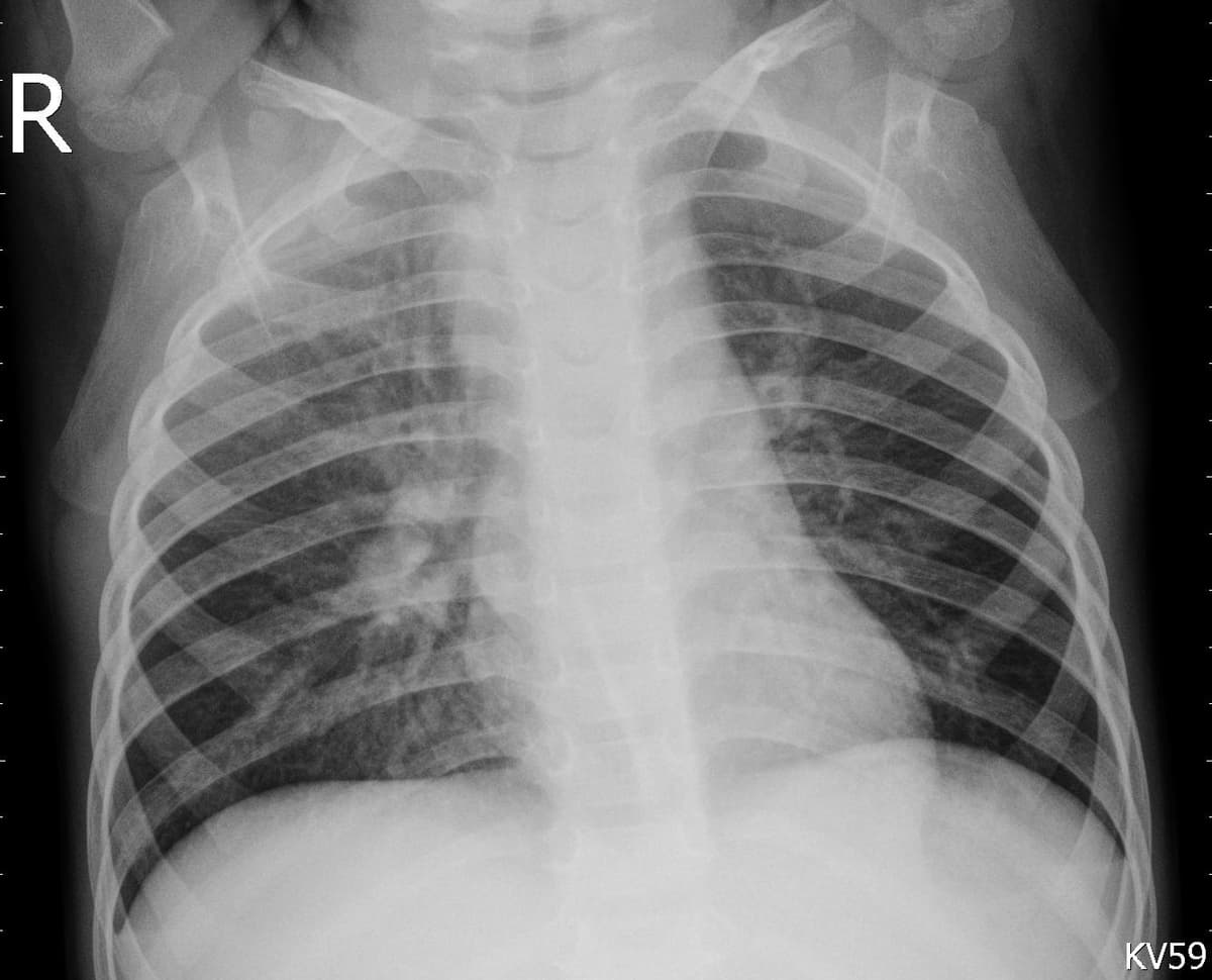Pneumonia — NIH Chest X-ray14