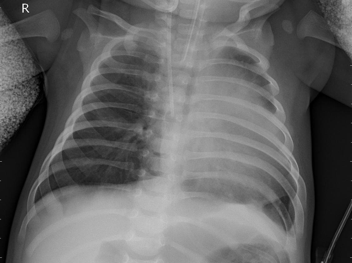 Pneumonia — NIH Chest X-ray14