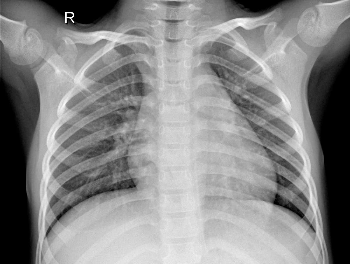 Radiografia Normal — NIH Chest X-ray14