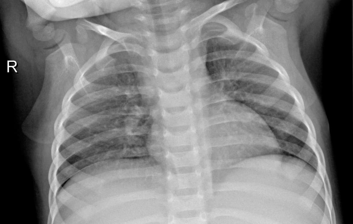 Radiografia Normal — NIH Chest X-ray14