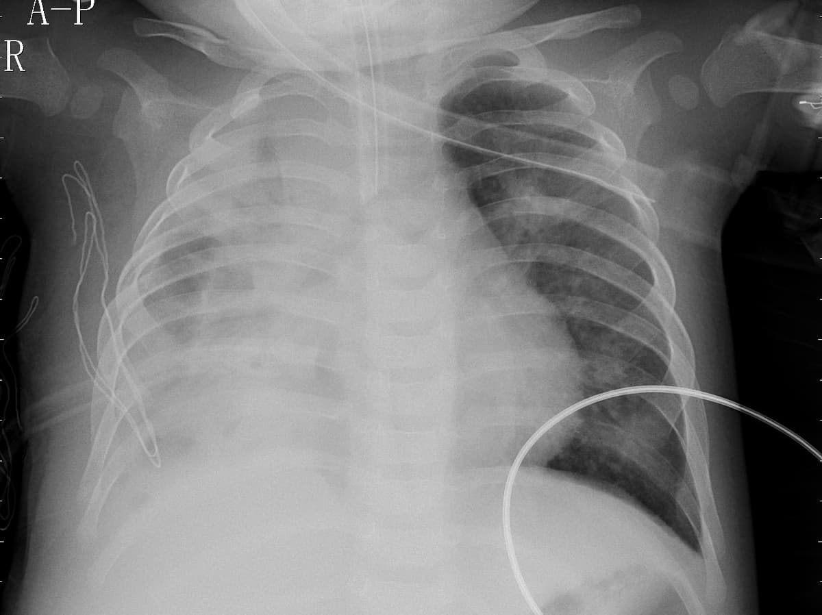 Pneumonia — NIH Chest X-ray14